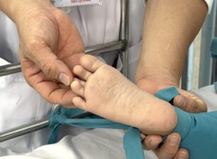 Bệnh tay chân miệng: Cha mẹ bình tĩnh, không phải cứ đưa trẻ lên tuyến trên là tốt nhất